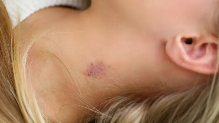 How Long Do Hickeys Last: Unraveling the Mystery Behind Love Bites